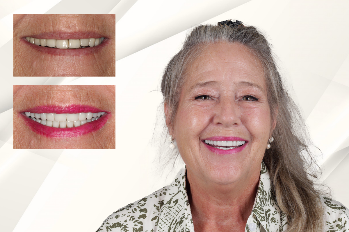 Tracey after her smile transformation